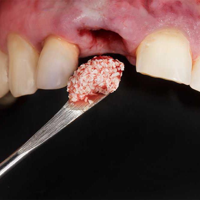 Implant Tedavisinde Kemik Greftleme