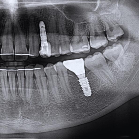 İmplantların Uzun Dönem Başarısı için; Sert ve yumuşak doku kayıplarının tedavi edilmesi.
