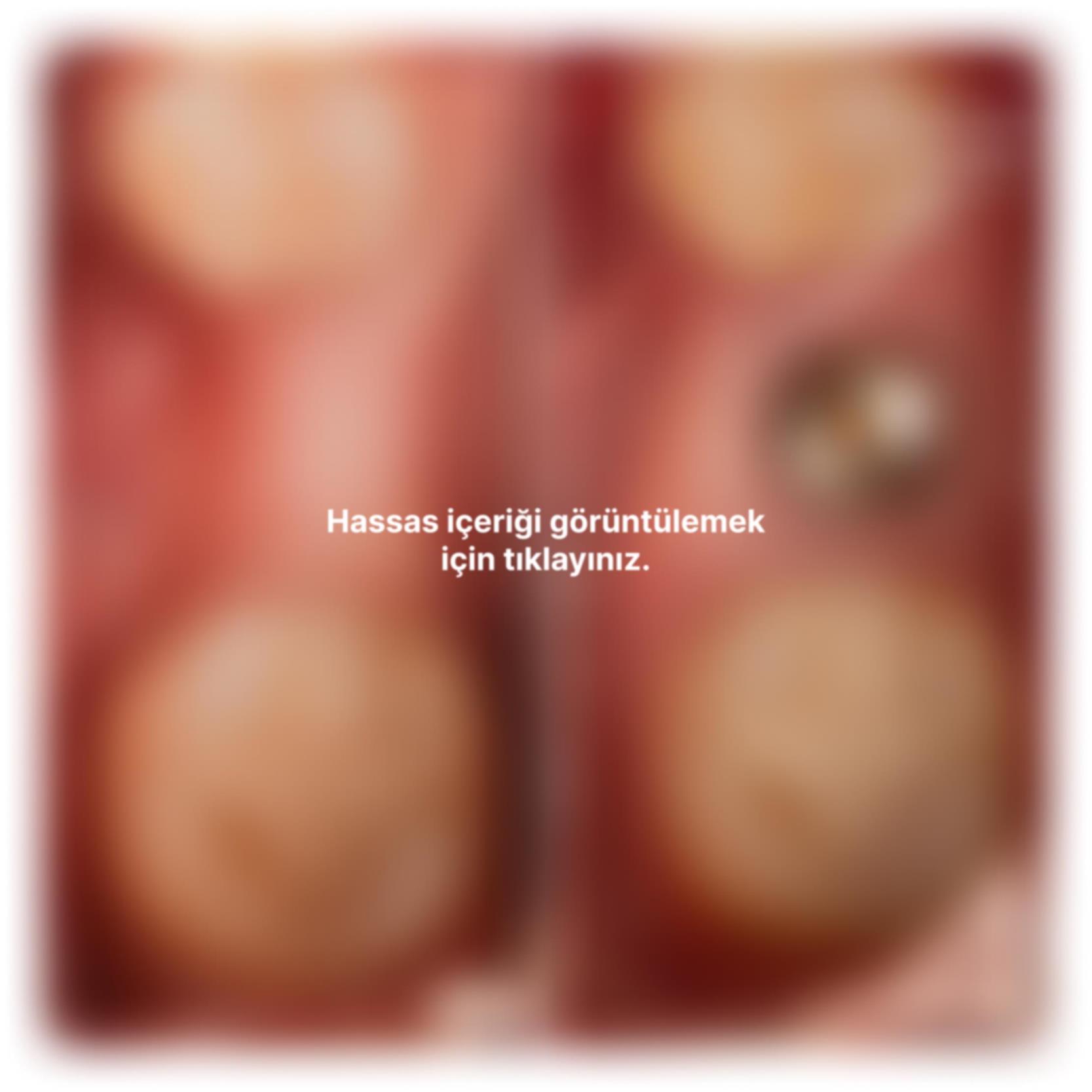 Kemik tozu ve PRF ile sert ve yumuşak doku ogmentasyonu yapıldı