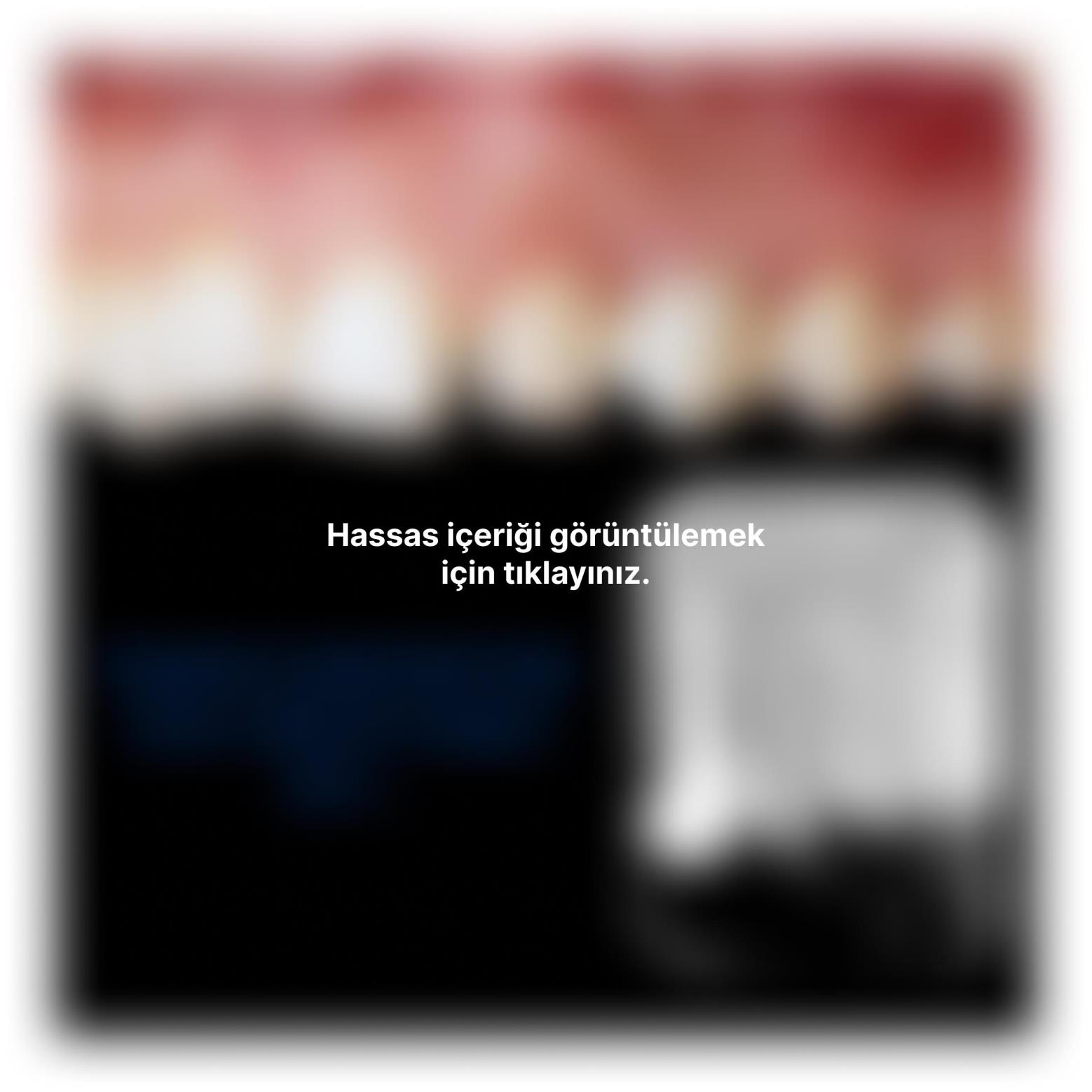 Başarılı bir implant tedavisi için kriterler nelerdir?