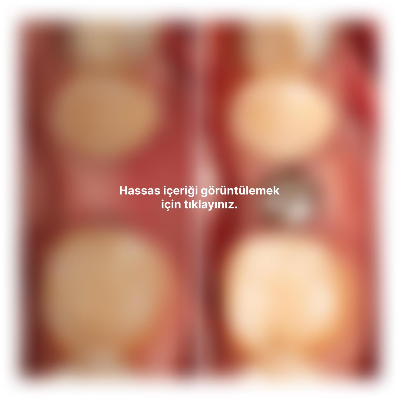 Sert ve yumuşak doku çöküntüsünü giderdiğimiz vakamız.