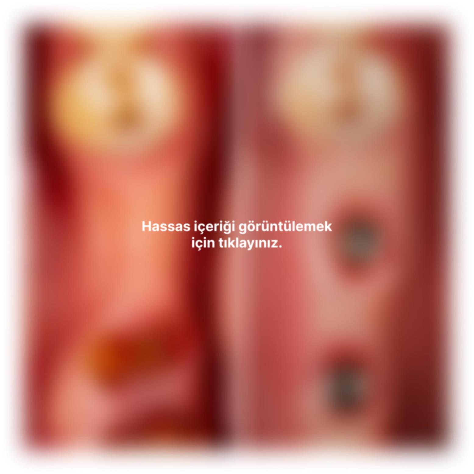 PRF destekli yumuşak doku greftlememiz ile diş etindeki çöküntü giderildi