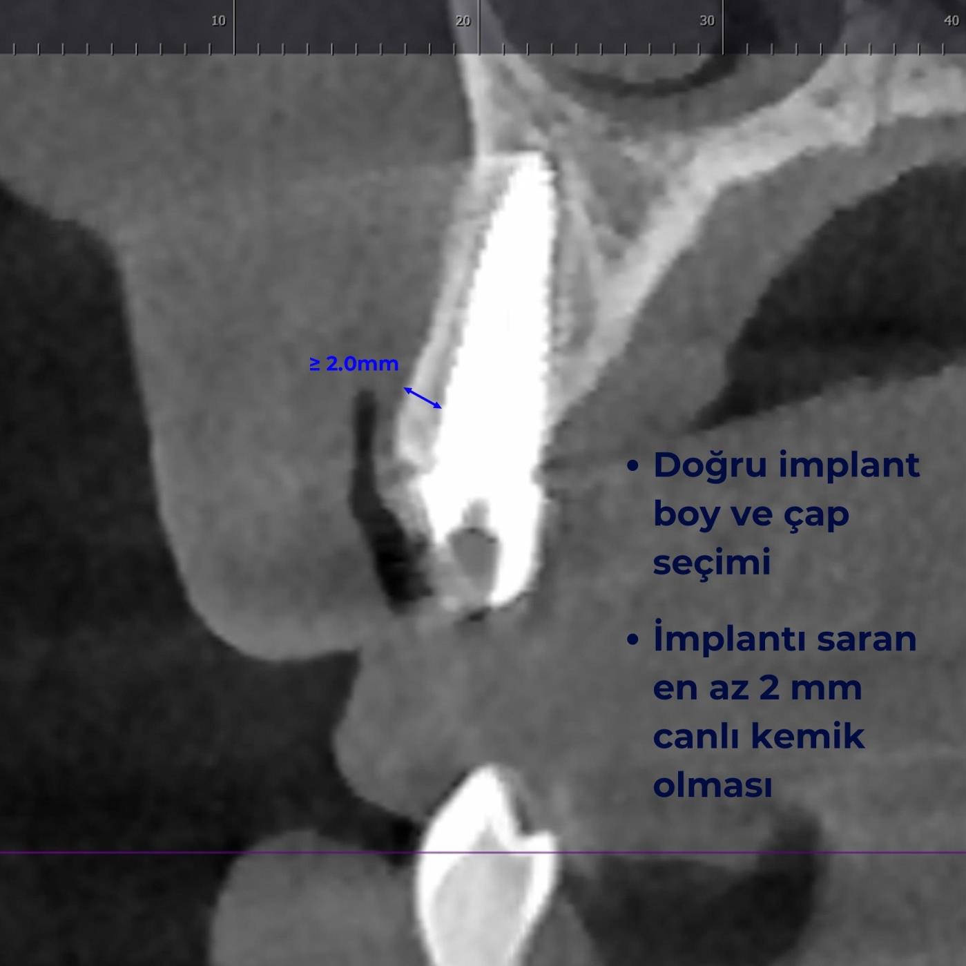 Başarılı bir implant tedavisi için kriterler nelerdir?