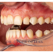 Başarılı bir implant tedavisi için kriterler nelerdir?