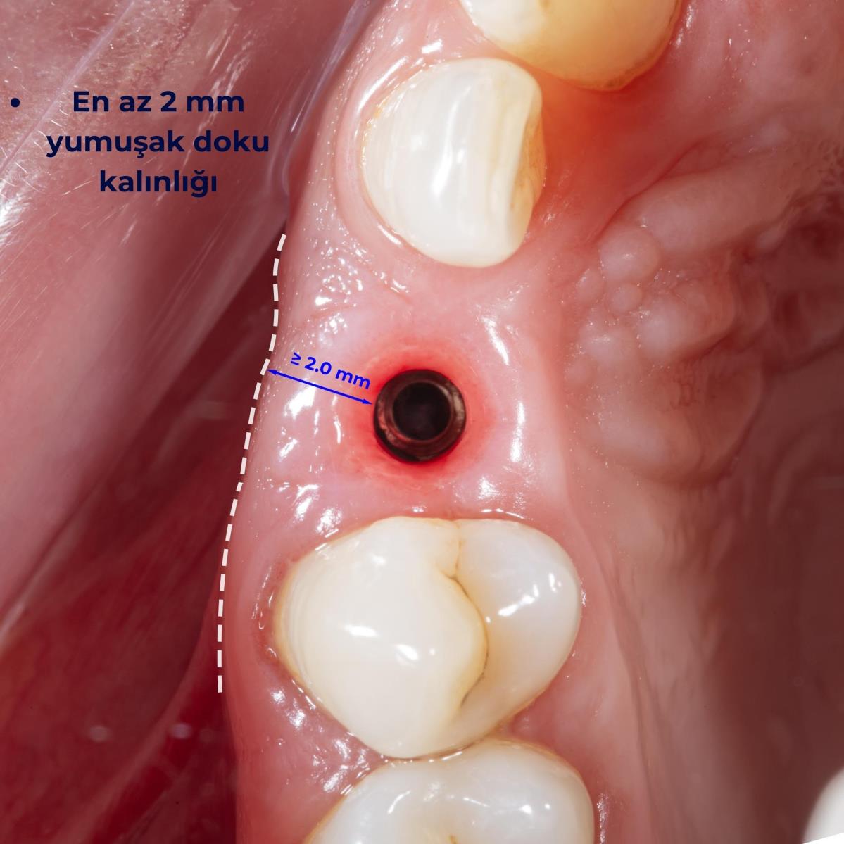 Başarılı bir implant tedavisi için kriterler nelerdir?
