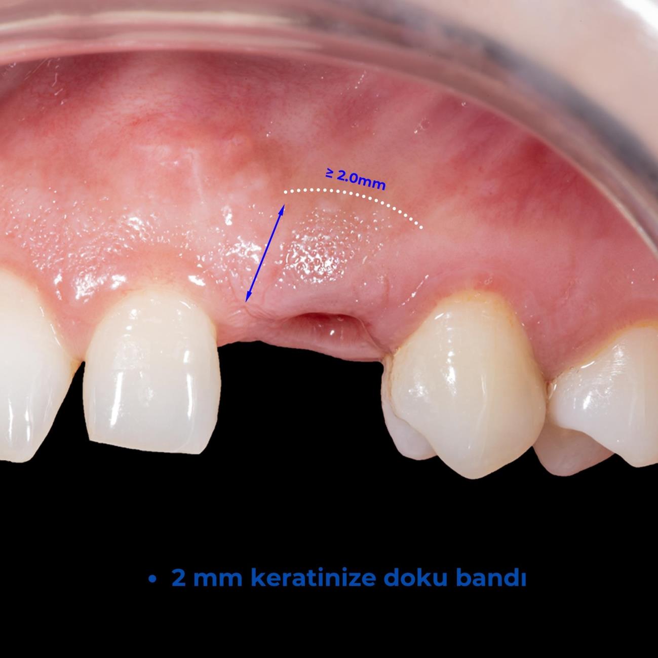 Başarılı bir implant tedavisi için kriterler nelerdir?