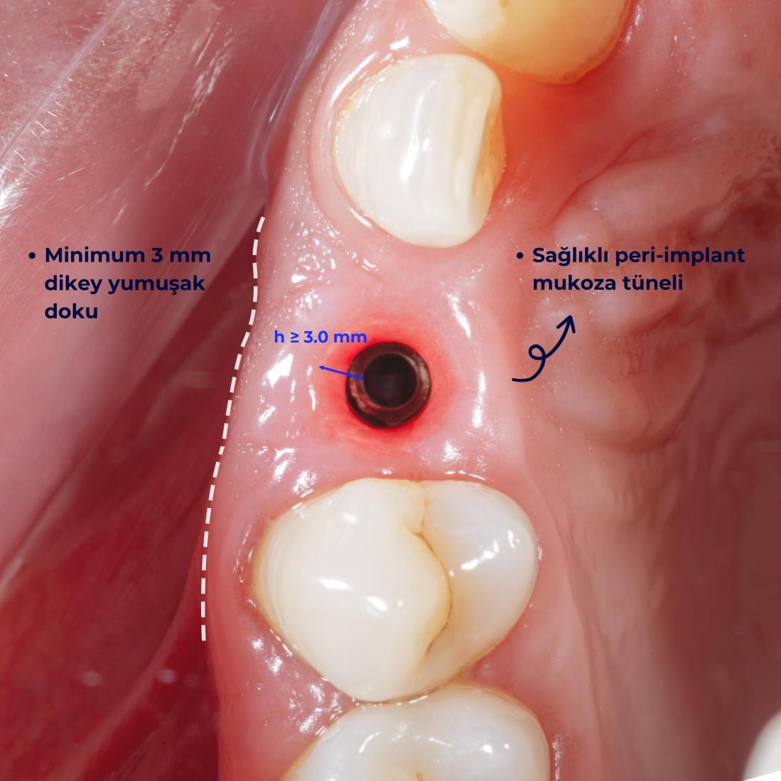 Başarılı bir implant tedavisi için kriterler nelerdir?