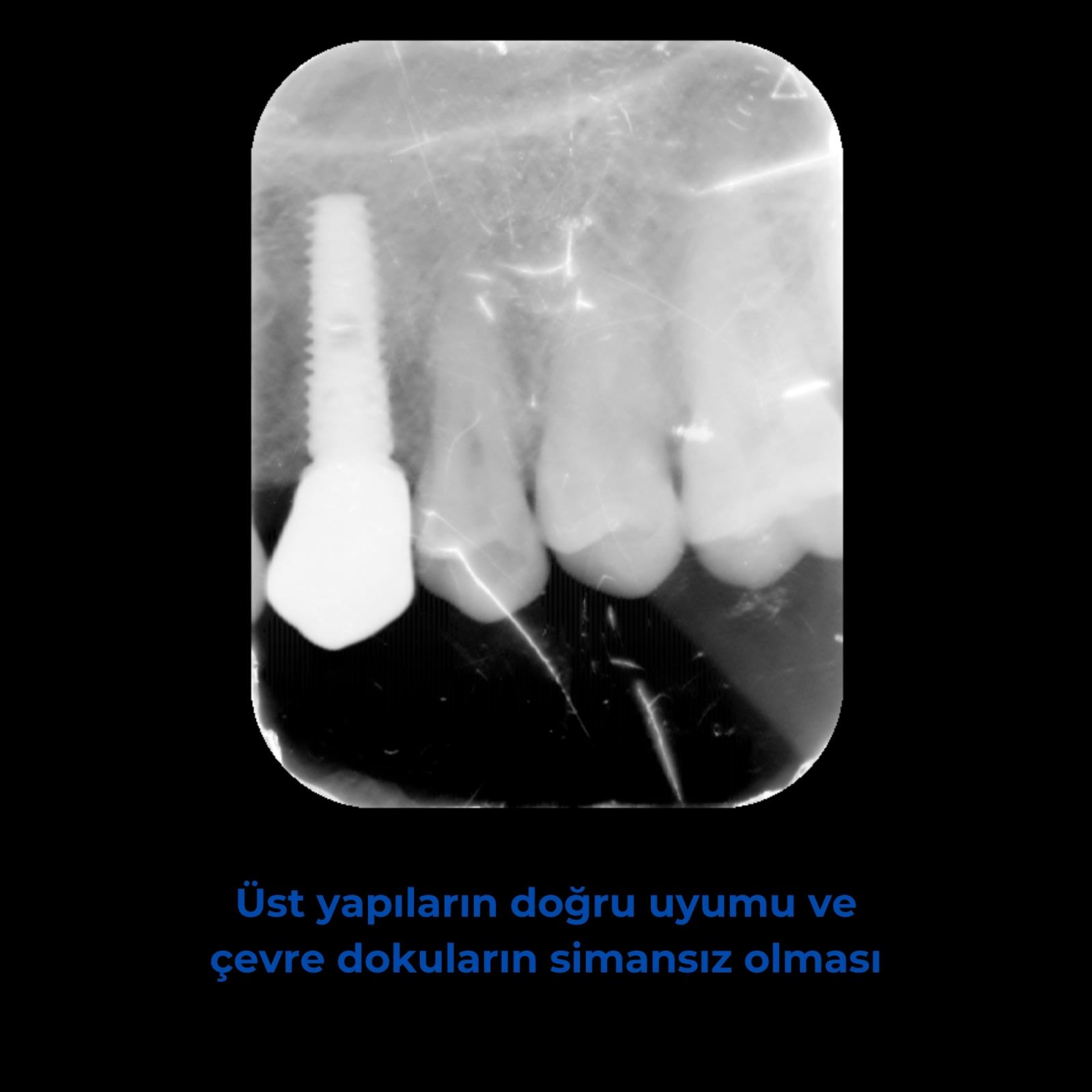 Başarılı bir implant tedavisi için kriterler nelerdir?