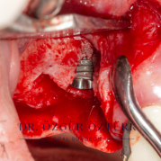 İmplant etrafındaki kemik açıklığını kemik grefti ile tedavi ettiğimiz vakamız