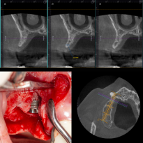 İmplant etrafındaki kemik açıklığını kemik grefti ile tedavi ettiğimiz vakamız