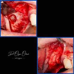 İmplant etrafındaki kemik açıklığını kemik grefti ile tedavi ettiğimiz vakamız