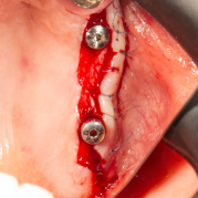 İmplant etrafındaki kemik açıklığını kemik grefti ile tedavi ettiğimiz vakamız