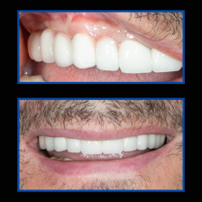 İmplant etrafındaki kemik açıklığını kemik grefti ile tedavi ettiğimiz vakamız