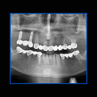 İmplant etrafındaki kemik açıklığını kemik grefti ile tedavi ettiğimiz vakamız