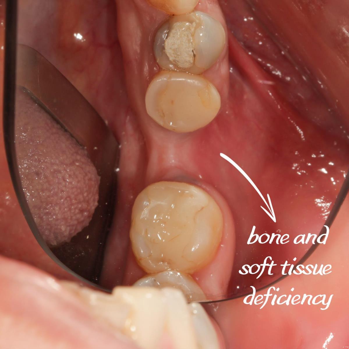Sert ve yumuşak doku çöküntüsünü giderdiğimiz vakamız.