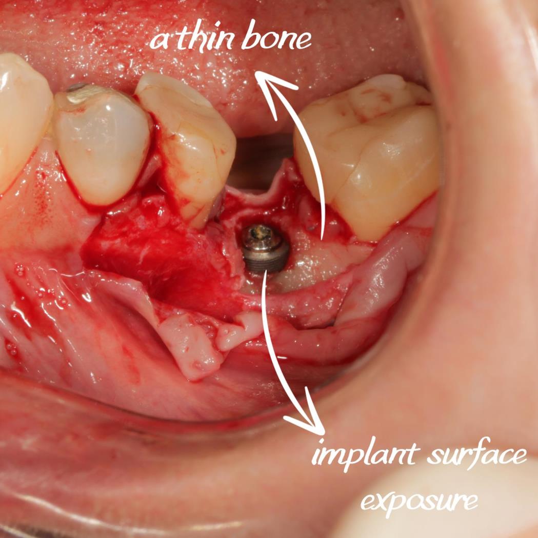 Sert ve yumuşak doku çöküntüsünü giderdiğimiz vakamız.