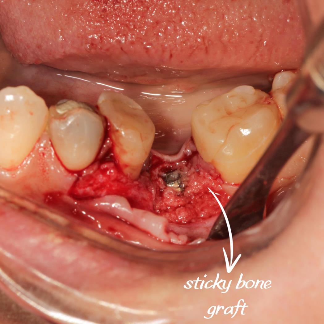 Sert ve yumuşak doku çöküntüsünü giderdiğimiz vakamız.