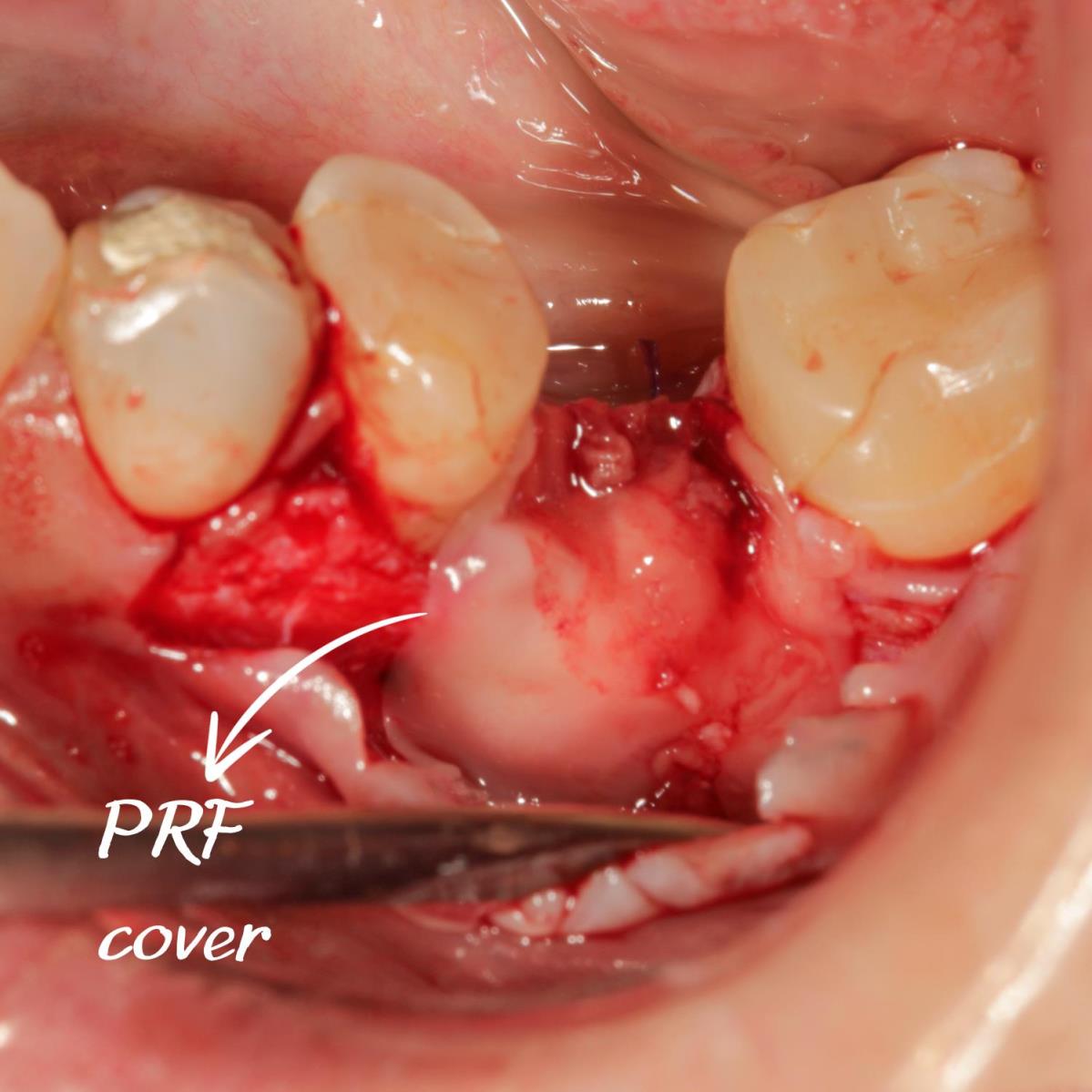 Sert ve yumuşak doku çöküntüsünü giderdiğimiz vakamız.