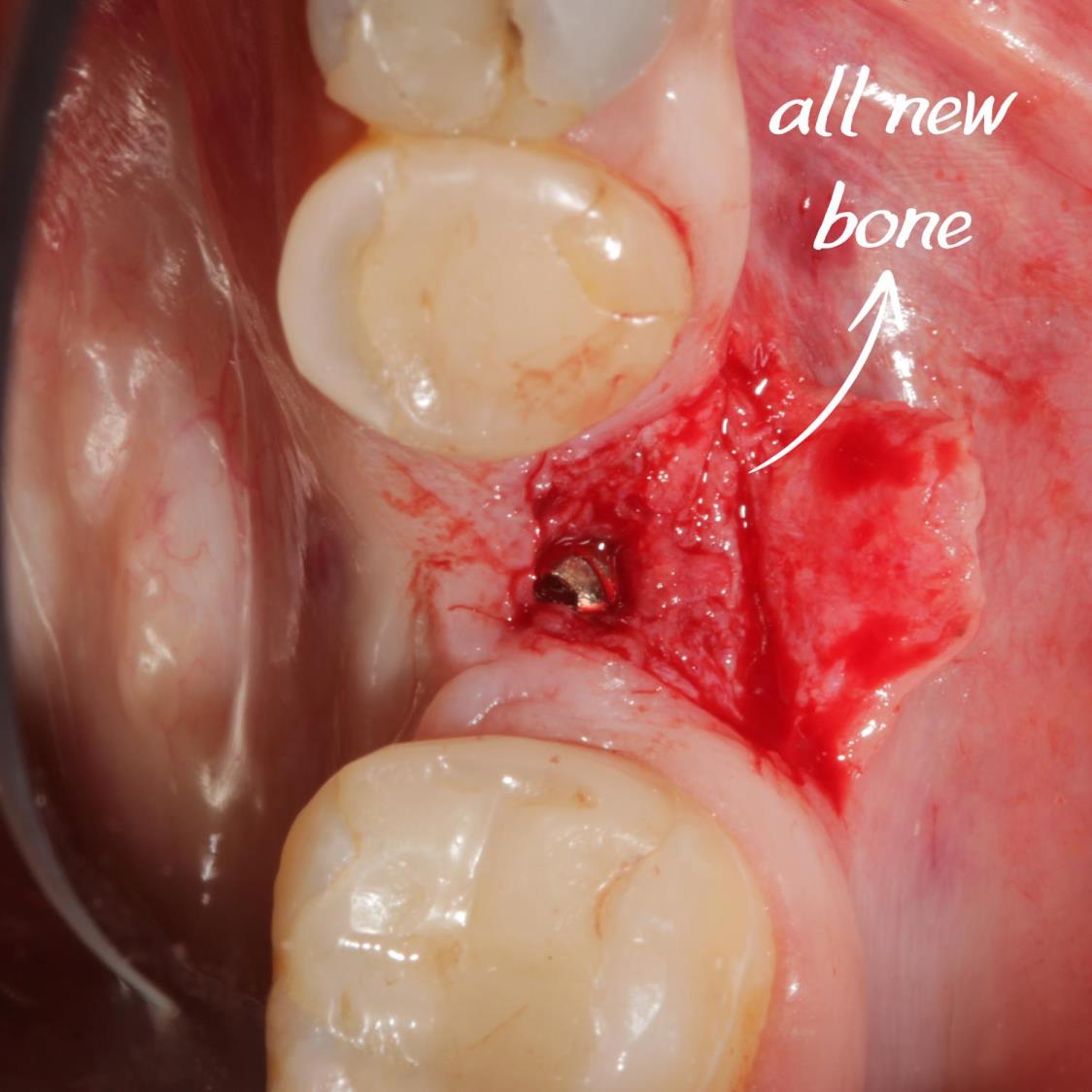 Sert ve yumuşak doku çöküntüsünü giderdiğimiz vakamız.