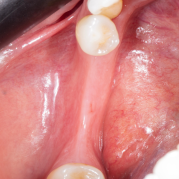 Diş çekiminin yıllar önce yapılmış olmasına bağlı olarak ince kemik varlığında implant ve kemik grefti uygulandı