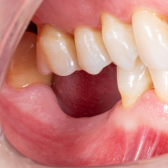 Diş çekiminin yıllar önce yapılmış olmasına bağlı olarak ince kemik varlığında implant ve kemik grefti uygulandı