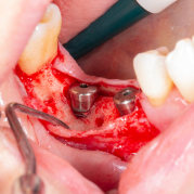 Diş çekiminin yıllar önce yapılmış olmasına bağlı olarak ince kemik varlığında implant ve kemik grefti uygulandı