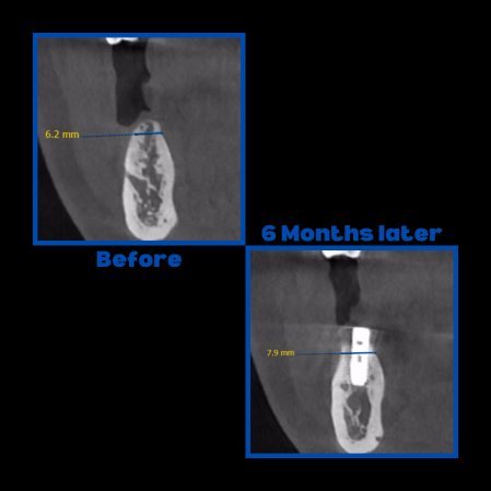 Diş çekiminin yıllar önce yapılmış olmasına bağlı olarak ince kemik varlığında implant ve kemik grefti uygulandı