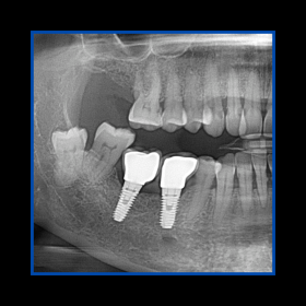 Diş çekiminin yıllar önce yapılmış olmasına bağlı olarak ince kemik varlığında implant ve kemik grefti uygulandı
