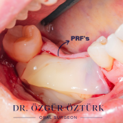 Diş çekiminin yıllar önce yapılmış olmasına bağlı olarak ince kemik varlığında implant ve kemik grefti uygulandı