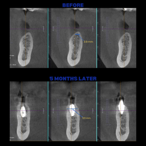 İmplant etrafındaki kemik açıklığını kemik grefti ile tedavi ettiğimiz vakamız