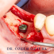 İmplant etrafındaki kemik açıklığını kemik grefti ile tedavi ettiğimiz vakamız