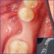 Kist nedeni ile çene kemiğinde defekt oluşmuş vakamıza sert ve yumuşak doku ogmentasyonu uyguladık