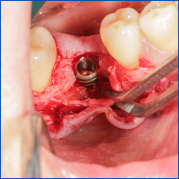 Kist nedeni ile çene kemiğinde defekt oluşmuş vakamıza sert ve yumuşak doku ogmentasyonu uyguladık