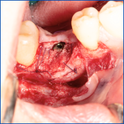 Kist nedeni ile çene kemiğinde defekt oluşmuş vakamıza sert ve yumuşak doku ogmentasyonu uyguladık