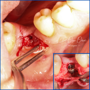 Kist nedeni ile çene kemiğinde defekt oluşmuş vakamıza sert ve yumuşak doku ogmentasyonu uyguladık
