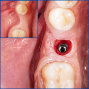Kist nedeni ile çene kemiğinde defekt oluşmuş vakamıza sert ve yumuşak doku ogmentasyonu uyguladık
