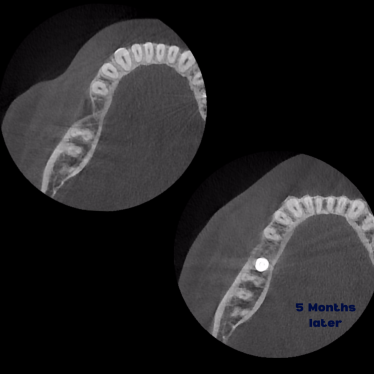 Kist nedeni ile çene kemiğinde defekt oluşmuş vakamıza sert ve yumuşak doku ogmentasyonu uyguladık