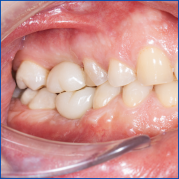 Kist nedeni ile çene kemiğinde defekt oluşmuş vakamıza sert ve yumuşak doku ogmentasyonu uyguladık