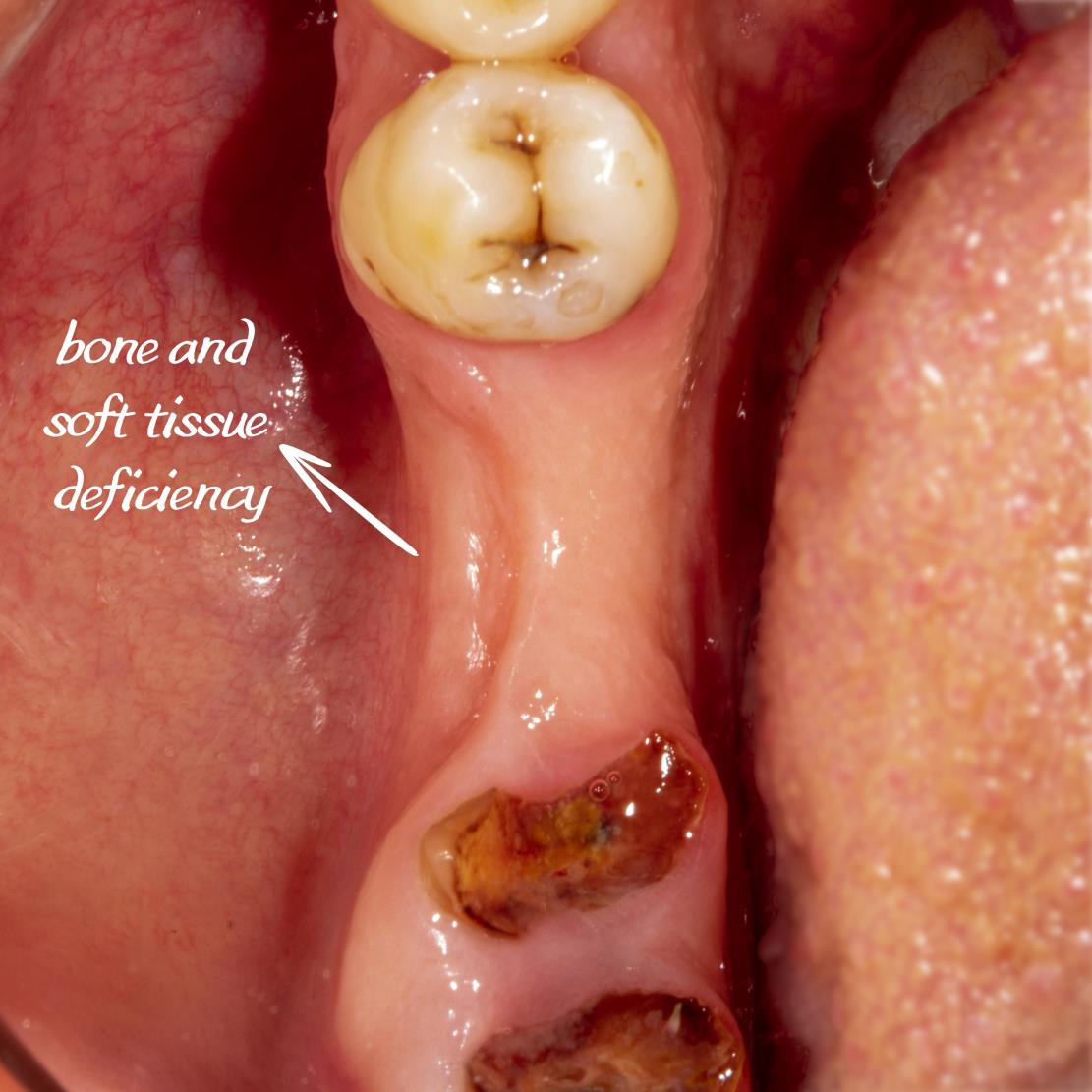 PRF destekli yumuşak doku greftlememiz ile diş etindeki çöküntü giderildi