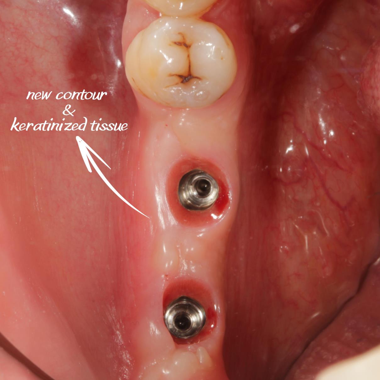 PRF destekli yumuşak doku greftlememiz ile diş etindeki çöküntü giderildi