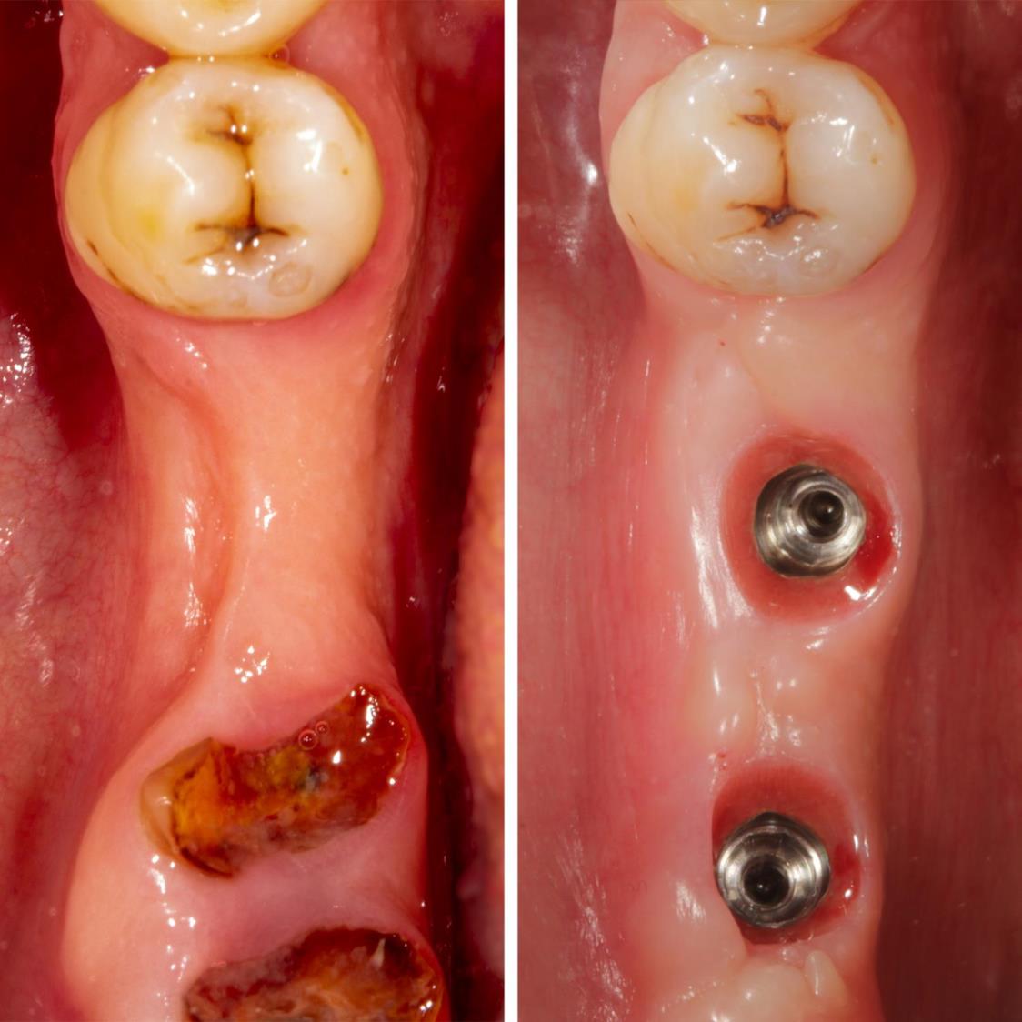 PRF destekli yumuşak doku greftlememiz ile diş etindeki çöküntü giderildi