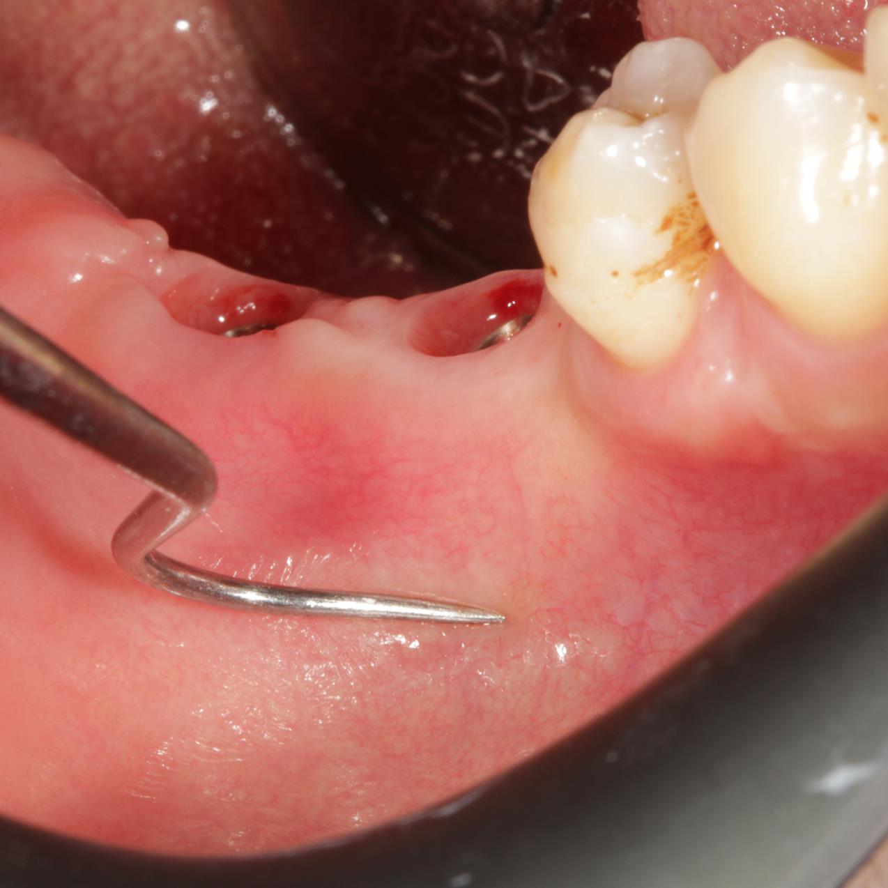 PRF destekli yumuşak doku greftlememiz ile diş etindeki çöküntü giderildi