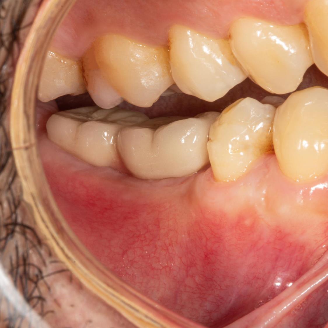 PRF destekli yumuşak doku greftlememiz ile diş etindeki çöküntü giderildi