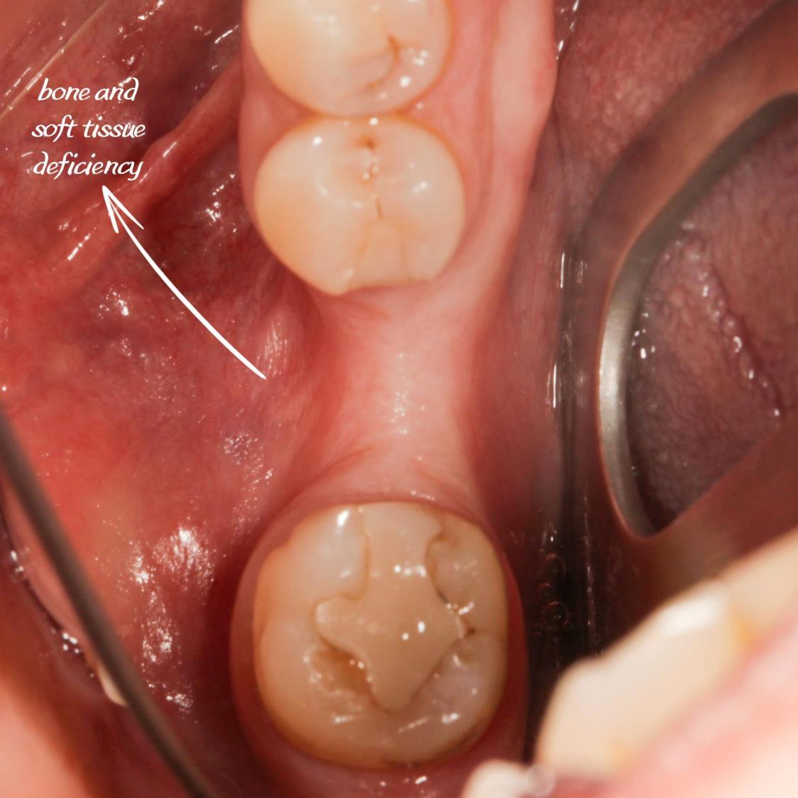Kemik tozu ve PRF ile sert ve yumuşak doku ogmentasyonu yapıldı