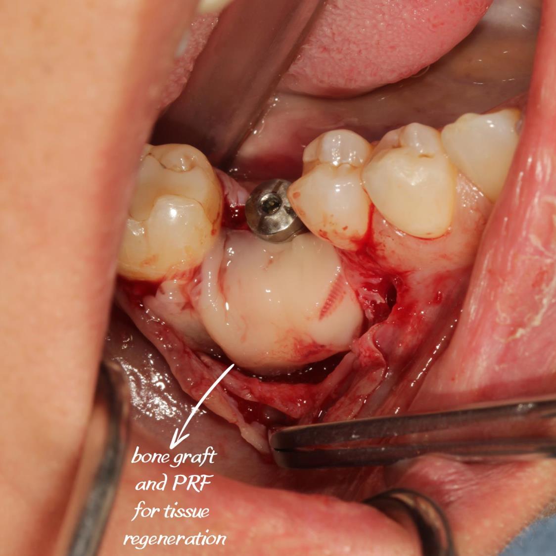 Kemik tozu ve PRF ile sert ve yumuşak doku ogmentasyonu yapıldı