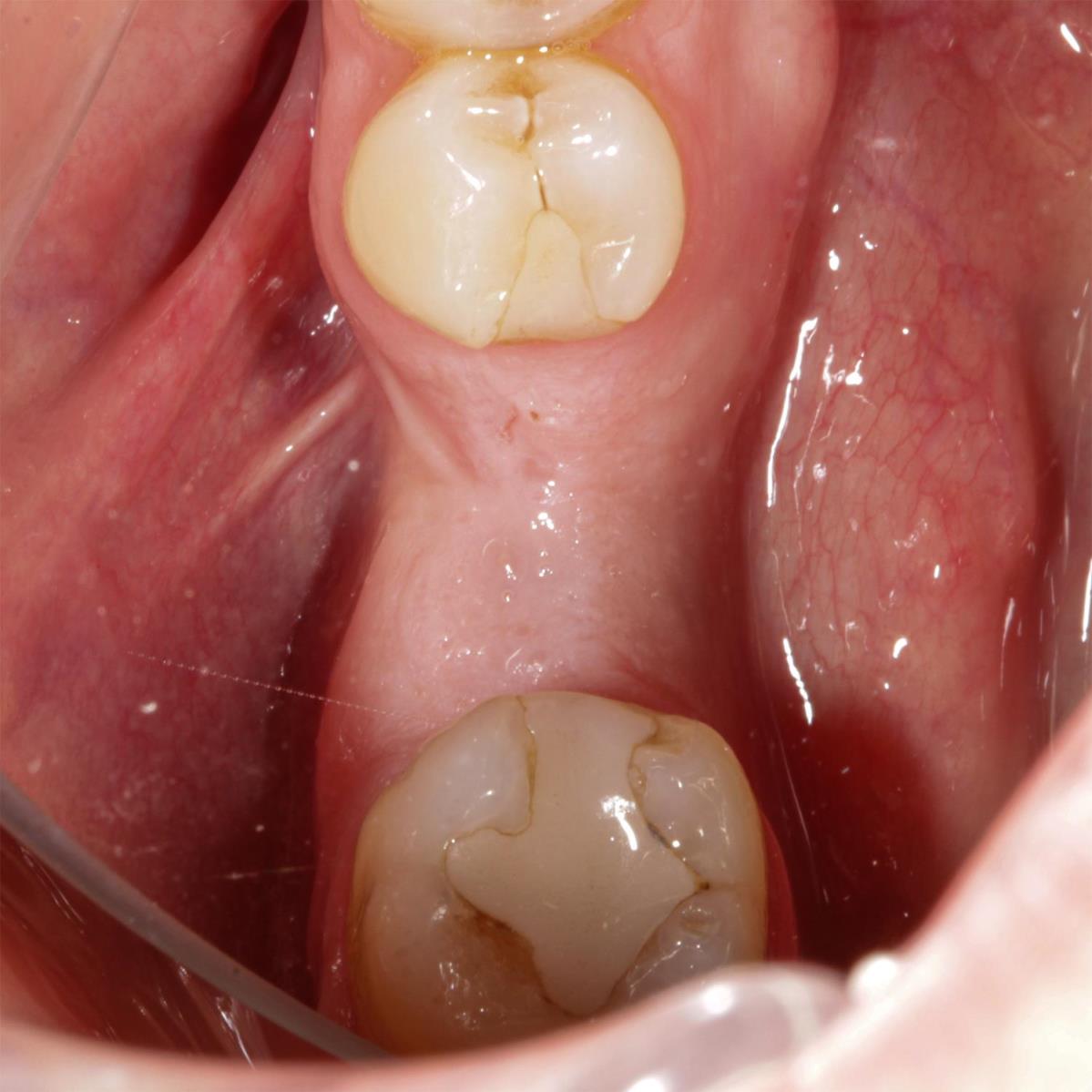 Kemik tozu ve PRF ile sert ve yumuşak doku ogmentasyonu yapıldı
