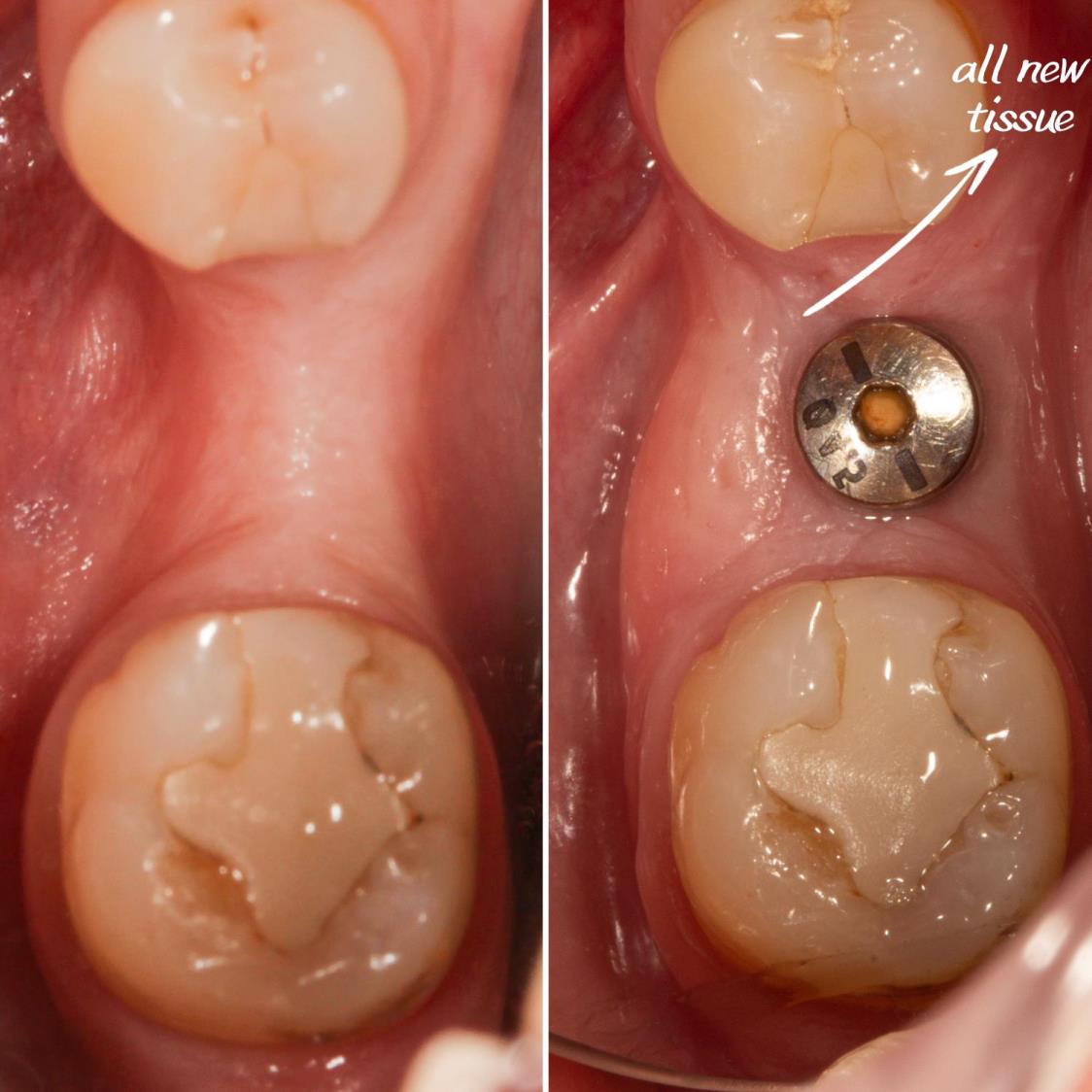 Kemik tozu ve PRF ile sert ve yumuşak doku ogmentasyonu yapıldı