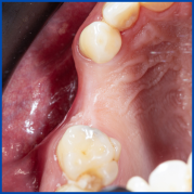 İnce kemik varlığında biorejenerasyon destekli kemik tozu uygulamamız ile yeni kemik oluşumu