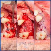 İnce kemik varlığında biorejenerasyon destekli kemik tozu uygulamamız ile yeni kemik oluşumu