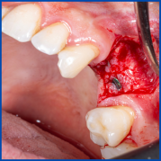 İnce kemik varlığında biorejenerasyon destekli kemik tozu uygulamamız ile yeni kemik oluşumu